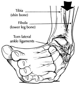 ankle_sprain