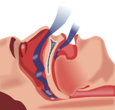sleep apnea pic