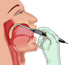 sleep apnea surgery
